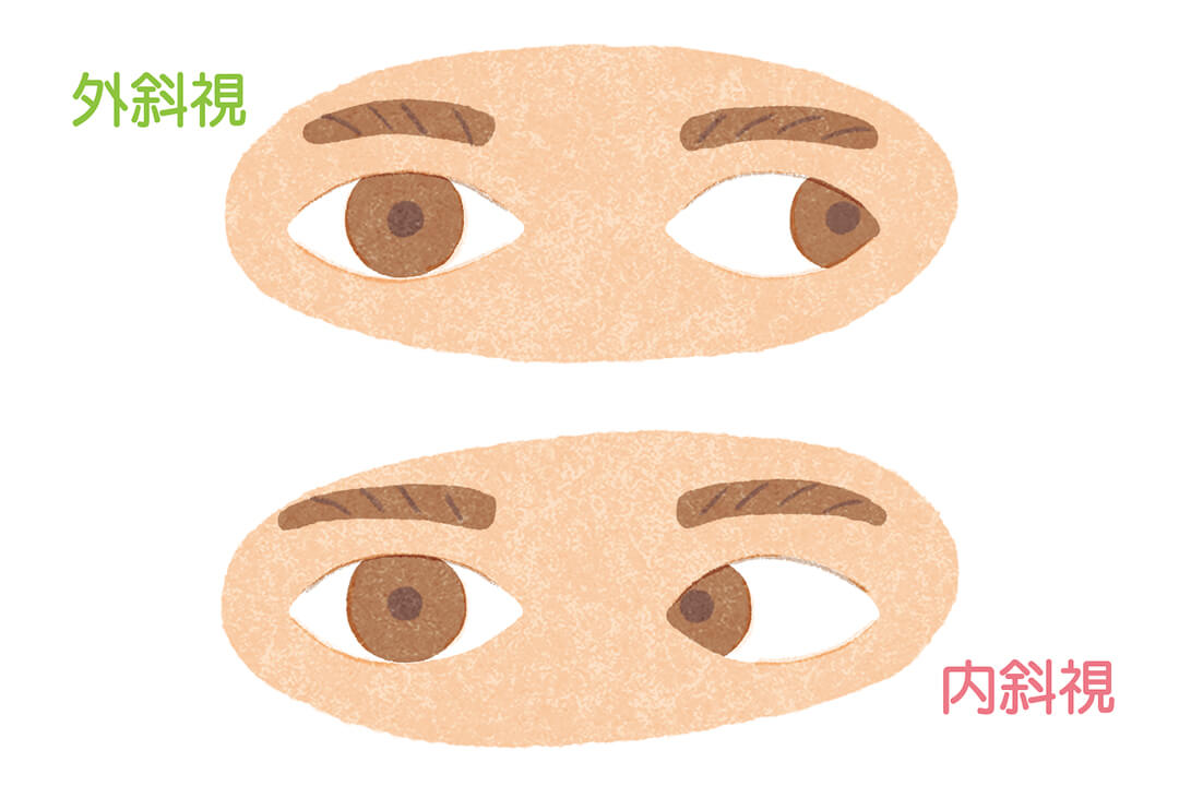 よく観察して見つけよう！子どもの目の不調サイン