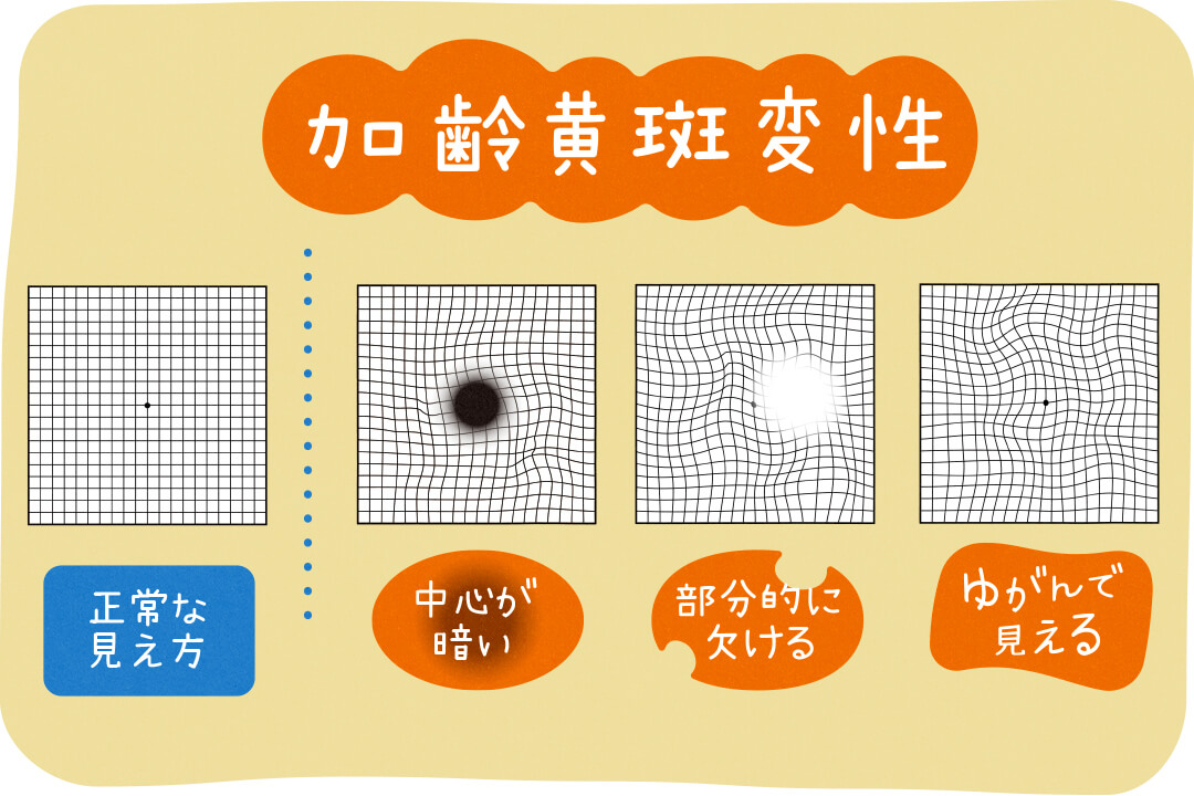 早期発見が大事！気をつけたい目のトラブル・病気