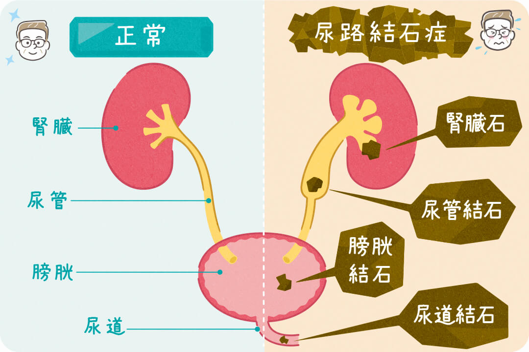 series-menshealthcare-nyokankesseki-cut01