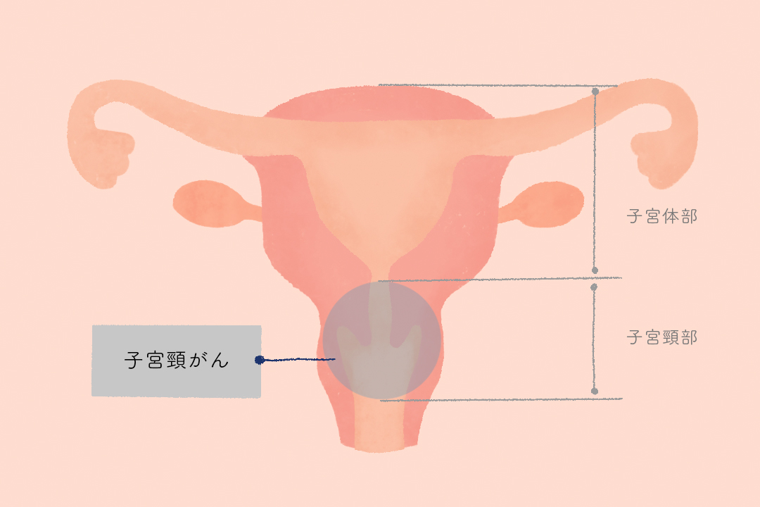series-healthcare-cervicalcancer-cut01