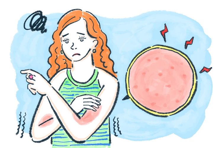 あせもや金属アレルギー、汗による肌トラブルと対策