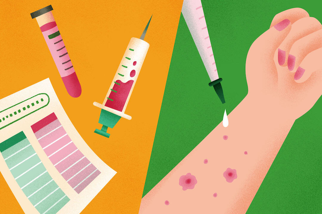 アレルギーはなぜ起こる？発症のメカニズムを知ろう