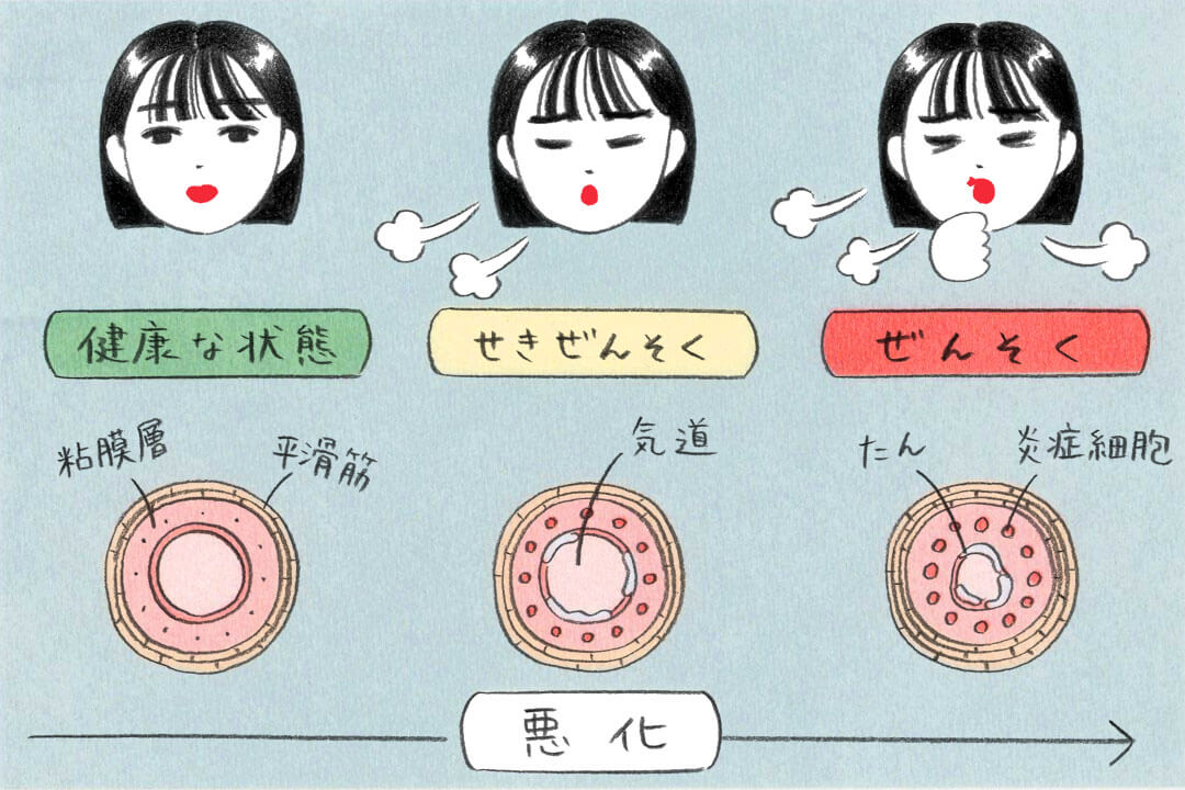 長引く空咳。大人も気をつけたい「咳喘息」って？