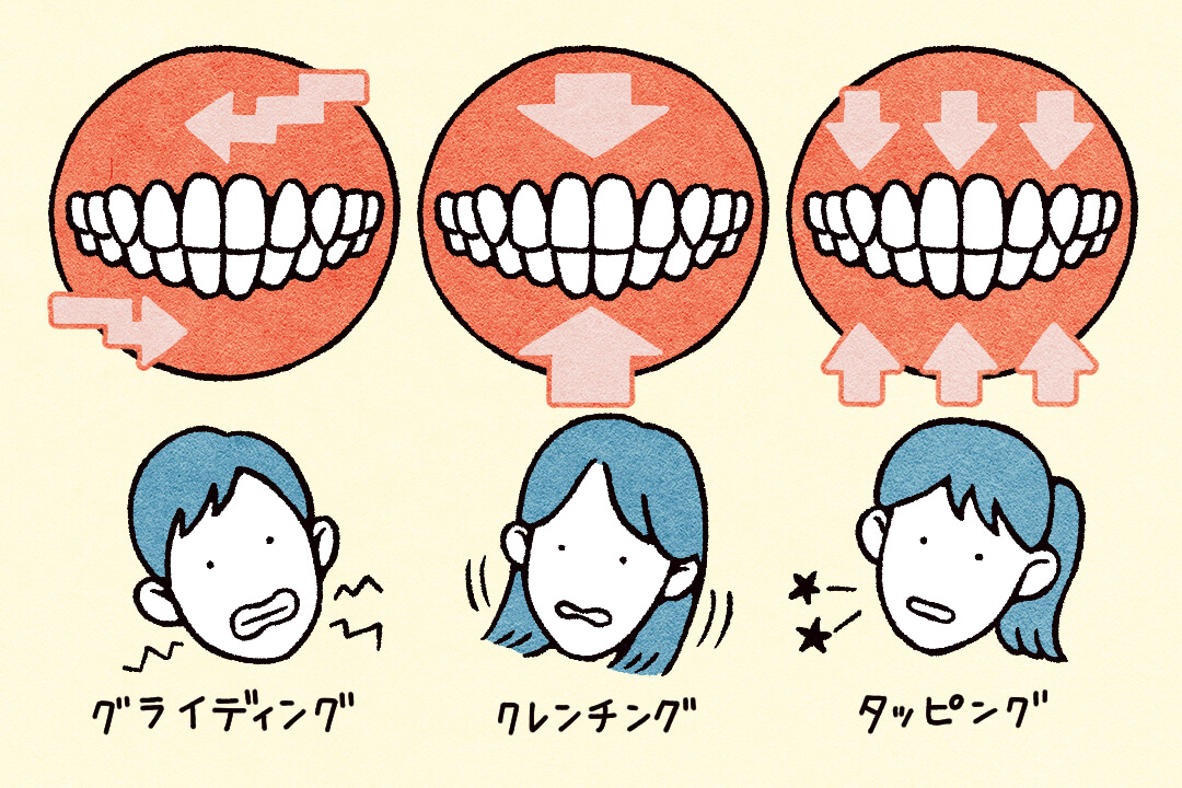 歯が割れる、抜ける!?歯ぎしり・食いしばりの改善策