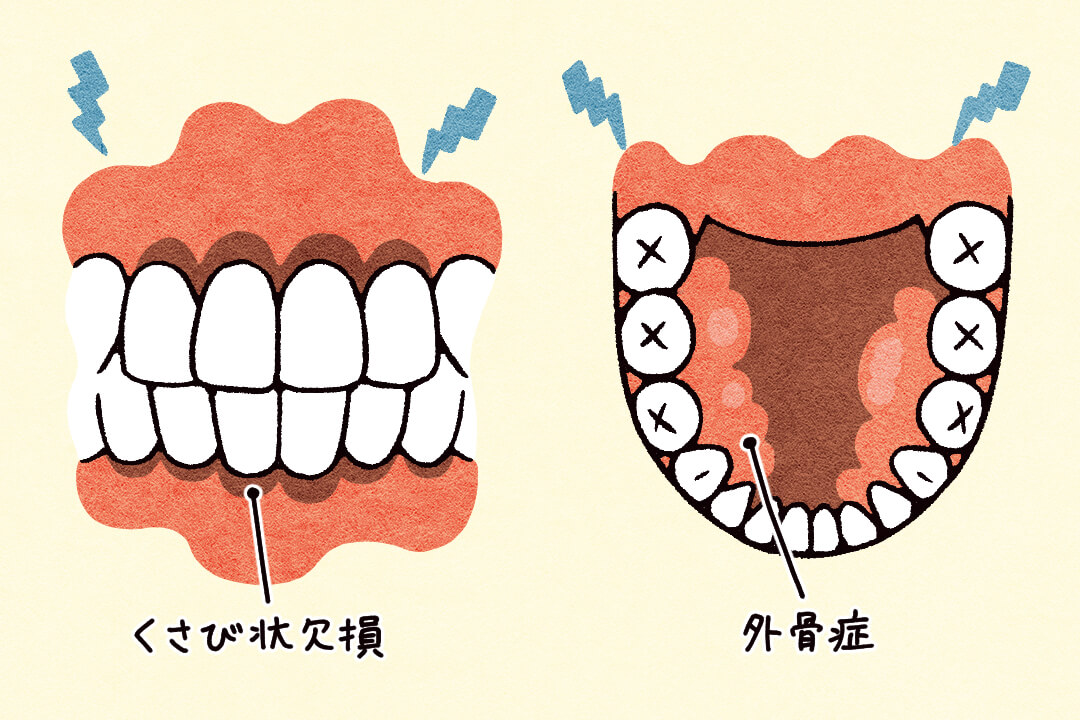 歯が割れる、抜ける!?歯ぎしり・食いしばりの改善策