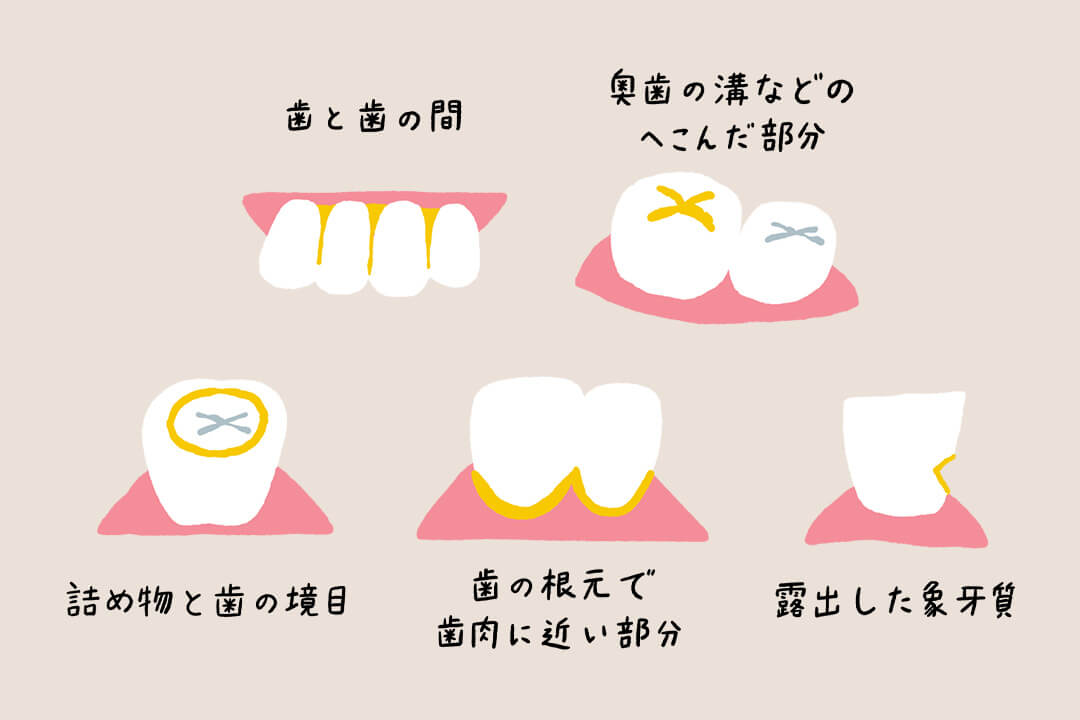 歯を失う原因「虫歯と歯周病」の基礎知識＆予防のコツ