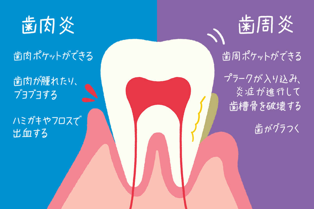 歯を失う原因「虫歯と歯周病」の基礎知識＆予防のコツ