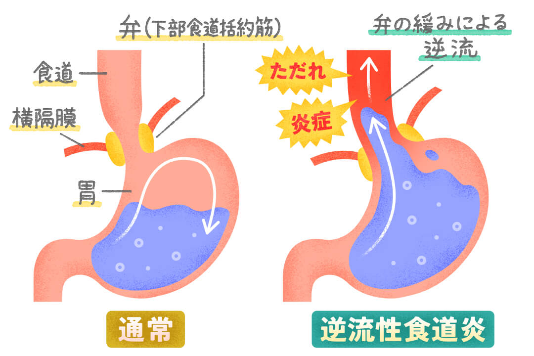 近年増加中！咳の原因にもなる「逆流性食道炎」