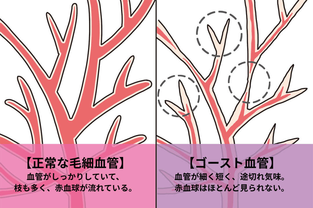 正常な毛細血管とゴースト血管のちがい