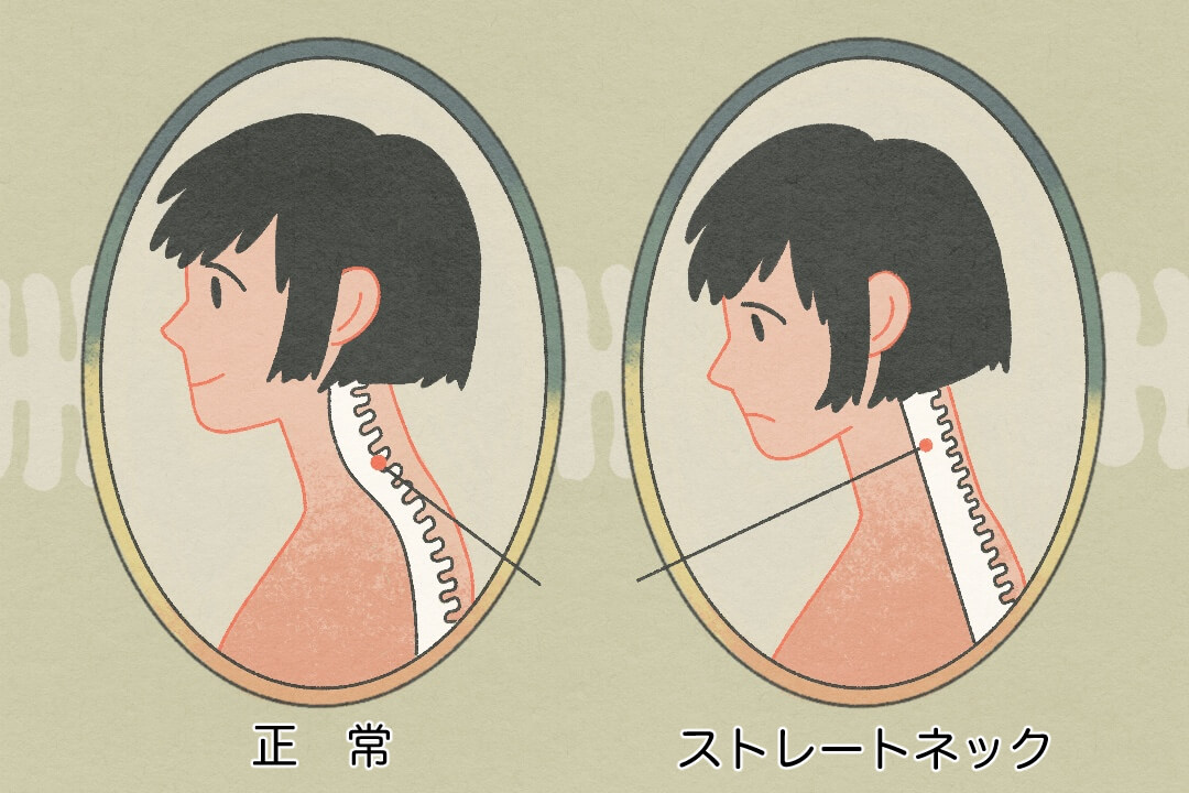 ストレートネックの人と正常な人のちがい