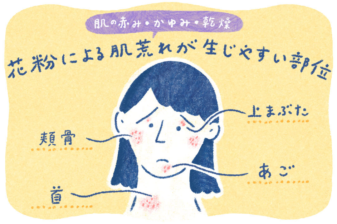 pollen-dermatitis-cut01