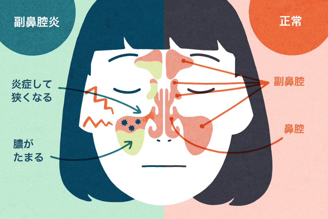 正常な状態と副鼻腔炎の状態