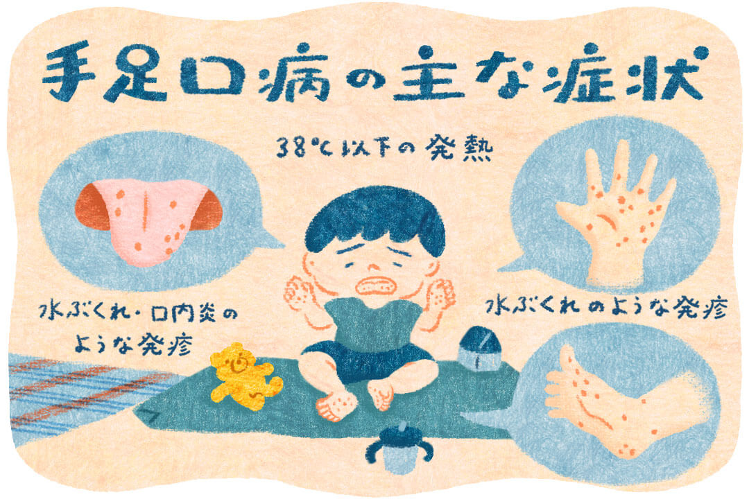 手足口病の主な症状